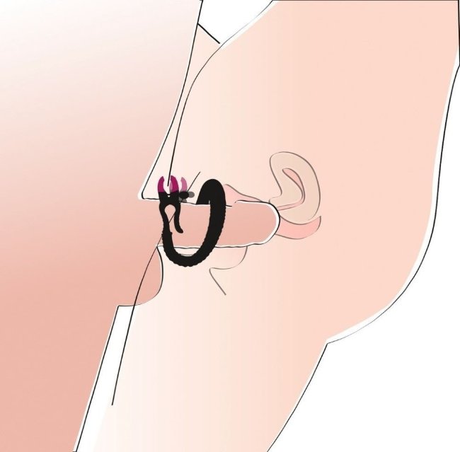 Зажим на половые губы с гибким соединителем Зажим на половые губы с гибким соединителем